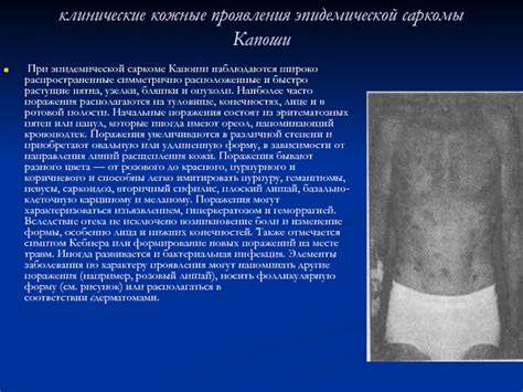 Кожные проявления СПИДА Картинка - Кожные проявления СПИДА