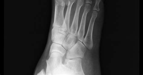 National Institute Of Foot Ankle Surgery Avulsion Fracture Base Of