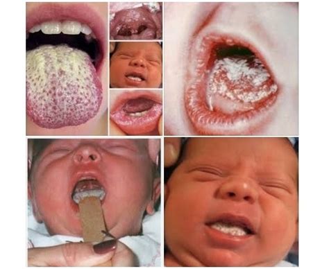 Apabila mendapati lidah bayi putih, anda perlulah mencucinya seawal mungkin supaya susu ini tidak berkumpul. Jangkitan Kulat Pada Mulut Bayi