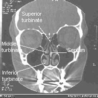 Ct anatomy of para nasal sinuses. Nasal cavity Facts for Kids