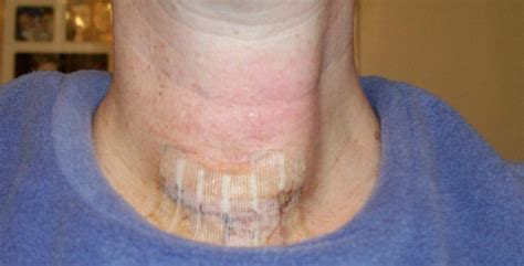 Thyroid Surgery Scar Next Could News