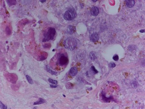 Pathology Outlines Adenovirus Hepatitis