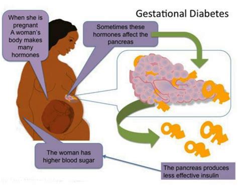 Gestational Diabetes The Danii Foundation
