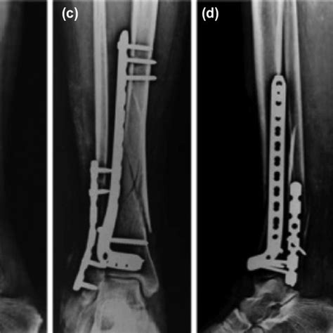Pre Operative Radiographs Of Intra Articular Distal Tibia Fibula