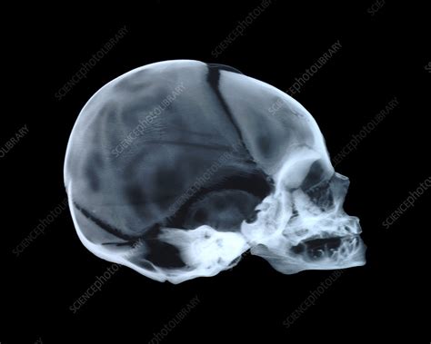 Babys Skull Stock Image P1200223 Science Photo Library