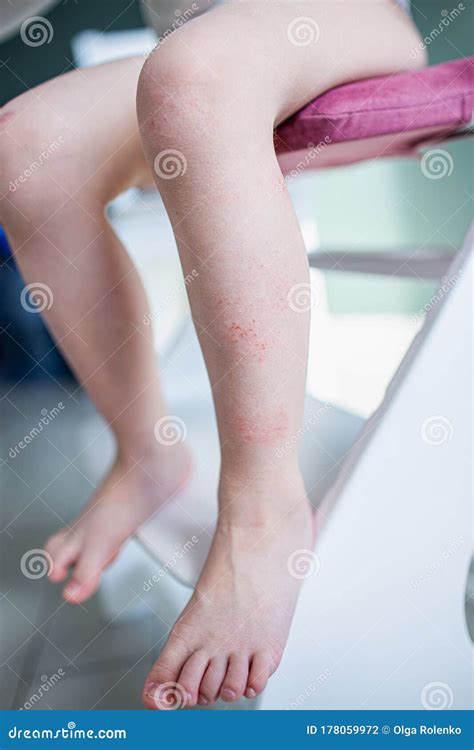 Close Up Eczema Atopic Dermatitis Symptom With Infected Skin On Child