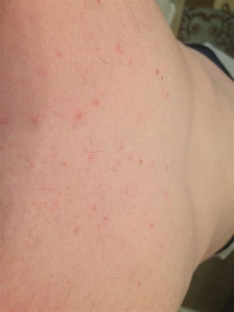 Does This Look Like Folliculitis Or Just Basic Acne On My Chest And