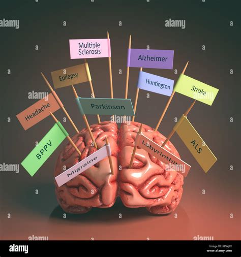 Enfermedades Del Cerebro Fotografía De Stock Alamy
