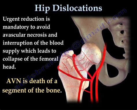 Hip Dislocations Everything You Need To Know Dr Nabil Ebraheim