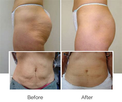 Weight Loss Hormone Pellets Before And After Willisbeaux