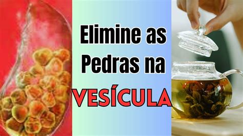 Remedios Caseiro Para Pedra Na Vesícula