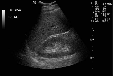 Normal Liver Echotexture On Ultrasound Radrounds Radiology Network