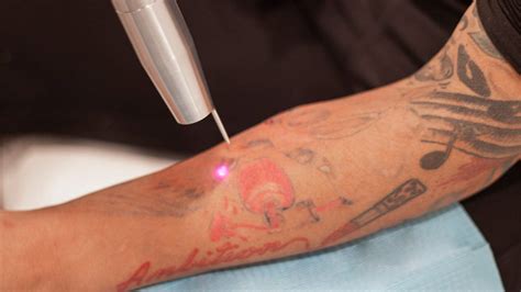 Everything You Need To Know About How Tattoos Are Removed Study Iq Education Blog