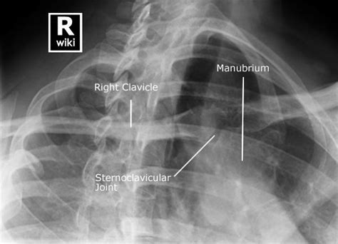 Sternoclavicular Joints Radiographic Anatomy Wikiradiography