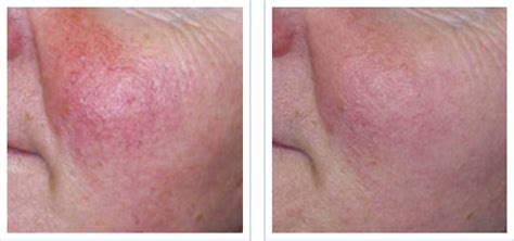 Rosacea Laser Treatments For Facial Flushing Beverly Hills