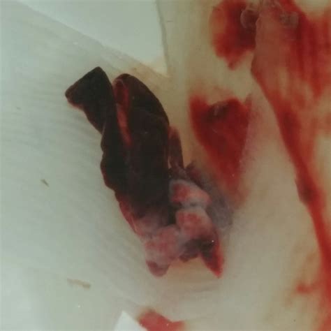 Clots Of Tissue From The Vagina Porn Galleries
