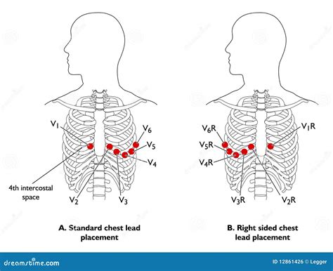 R Sided Ecg Lead Placement Article Blog