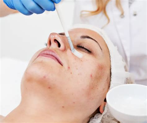 The Benefits Of Chemical Peels Skincare Beauty Ciya