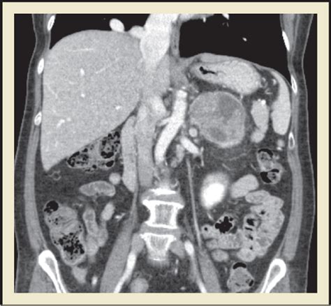 Juxta Adrenal Ancient Schwannoma A Rare Retroperitoneal Tumor