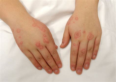 Hand rashes are a widespread problem because the hands come into contact with wind, dry air, soap, and many other irritating substances. Systemic Mastocytosis | Norway| PDF | PPT| Case Reports ...