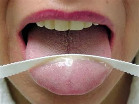 Yellow Tongue The Causes Of This Phenomenon Which Means The