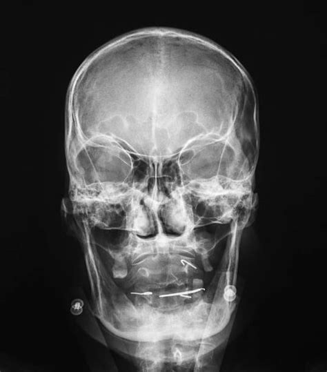 Frontal Sinus Osteoma Buyxraysonline