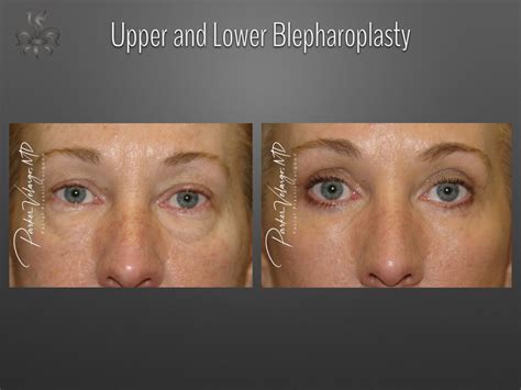 Blepharoplasty Eyelid Surgery Case 3606 New Orleans Premier Center