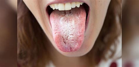 آیا رابطه دهانی باعث عفونت واژن می شود
