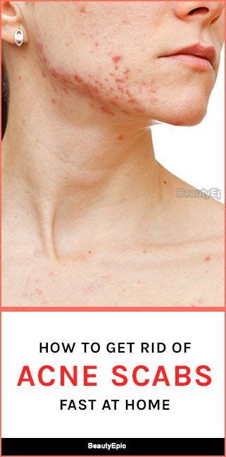 How To Get Rid Of Pimpleacne Scabs Naturally Acne Scab How To Get