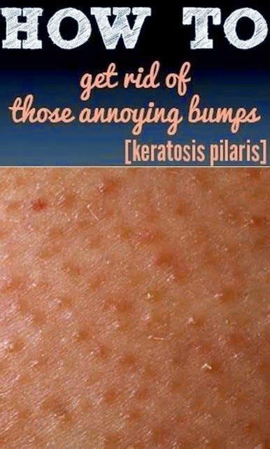 I take them out because they are on my face. How To Get Rid Of Arm Bumps a.k.a keratosis pilaris or ...