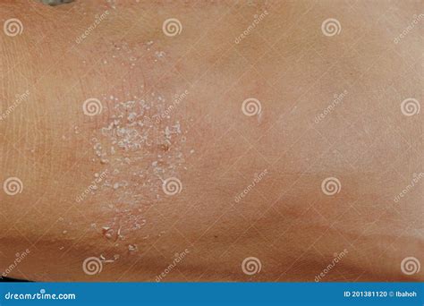 Allergic Itchy Skin Stock Photo Image Of Hygiene Allergy 201381120