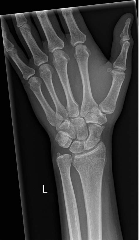 Wrist X Ray Anatomy