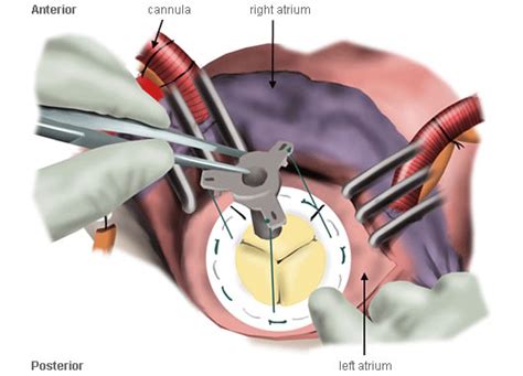 Mitral Valve Replacement Surgery Hunaid Vohra Mrcs Bristol