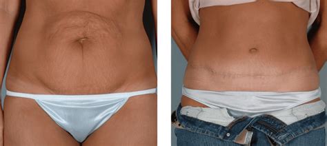 Abdominoplasty Before And After What You Need To Know Bellezie