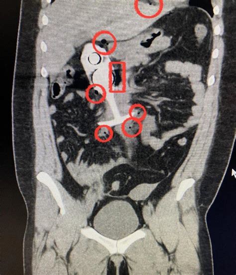 Which One Of You Wore A Butt Plug During An Mri Page 3 O T Lounge