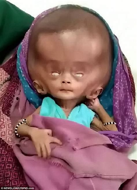 Indian Baby Born With Head Twice The Normal Size Daily Mail Online