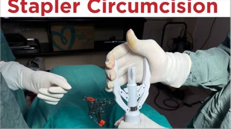 Stapler Circumcision Phimosisಶಿಶ್ನ ಮುಂದೊಗಲು ಸ್ಟಾಪ್ಲರ್ ಶಸ್ತ್ರ ಚಿಕಿತ್ಸೆdr C Sharath Kumar