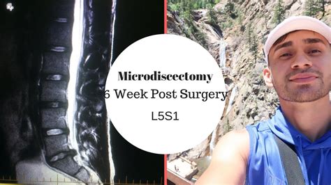 Microdiscectomy Week Post Surgery L S Youtube