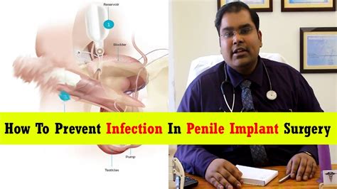 Preventing Infections In Penile Implant Surgery An Infected Implant Is A Useless Implant
