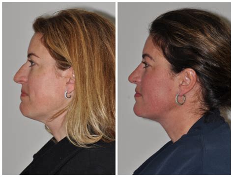 Neck Lift In Philadelphia Neck Lift In Bryn Mawr