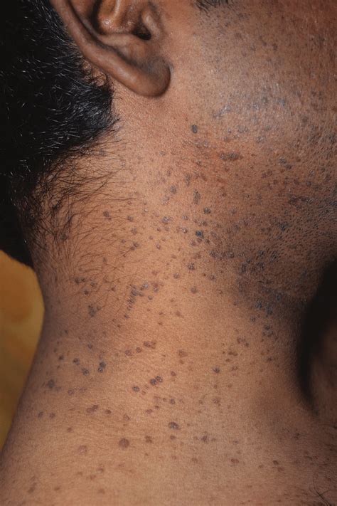 A Numerous Hyperpigmented Macules And Papules On The Neck B Numerous