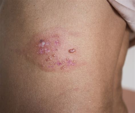 The herpes simplex virus is categorized into 2 types: Herpes Zoster Risk Greatly Increased in Psoriasis ...