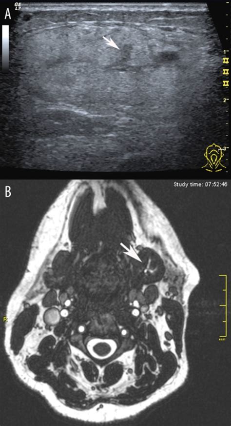 A Ultrasonogram Of The Left Submandibular Gland The Open I