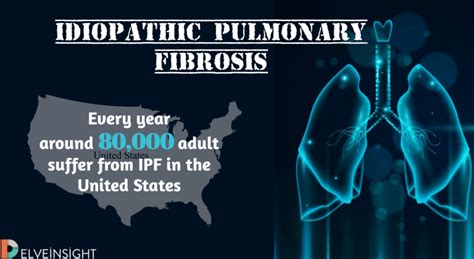 Idiopathic Pulmonary Fibrosis Scarring For A Lifetime Delveinsight