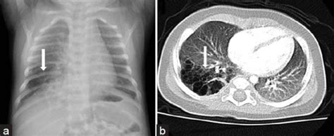 Sigles d'une seule lettre sigles de deux lettres sigles de trois lettres > sigles de quatre lettres … Type II congenital cystic adenomatoid malformation (CPAM ...