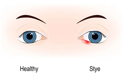 How To Get Rid Of A Swollen Eyelid Causes And Treatment Dr Tavel