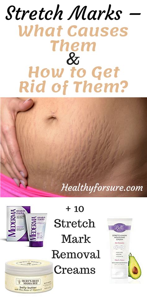 Stretch Marks What Causes Them And How To Get Rid Of Them Best