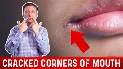 What Causes Cracked Corners Of Mouth Healing Saga