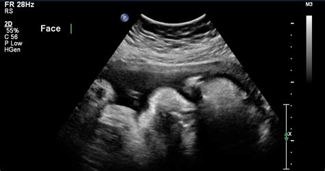 Here I Am 37 Week Sonogram And My Happy Baby