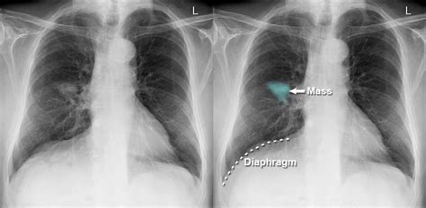 chest x ray lung cancer phrenic nerve palsy